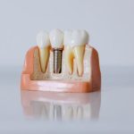 Impianto dentale e autostima: perché sostituire un dente cambia molto più del sorriso